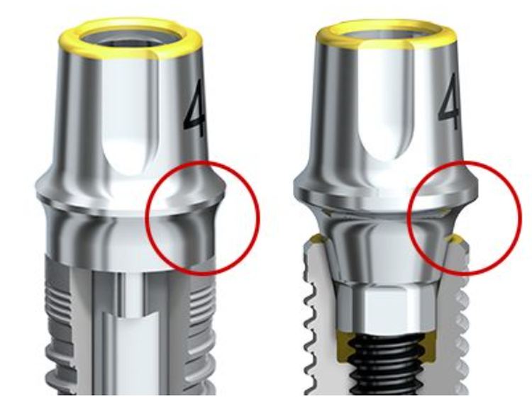 cena zobnih vsadkov cena zobnih vsadkov